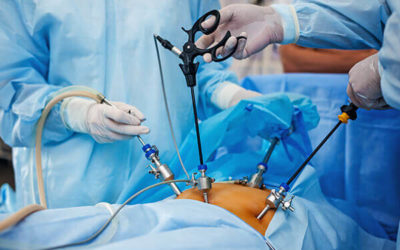 Laparoscopic surgery: fibromas extraction, endometriosis, hysterectomy, ovarian cyst extraction, polyp extraction