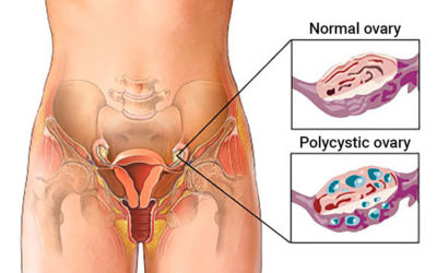Polycystic ovarian syndrome (PCOS)- Fertility check