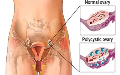 Polycystic ovarian syndrome (PCOS)- Fertility check